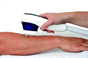 Trattamento estetico su braccio con apparecchio laser